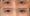 ผลลัพธ์โปรแกรม Endolift 3 เดือน